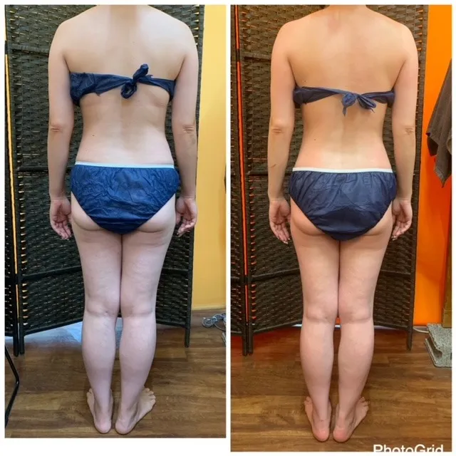 インドエステ(アーユルヴェーダ)症例